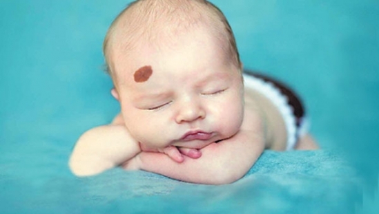 Những vết sẹo luân hồi: Vết bớt kỳ lạ của những đứa trẻ sơ sinh