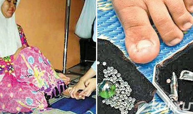 Cô gái Malaysia mang căn bệnh lạ, ngón chân không ngừng sinh ra kim cương