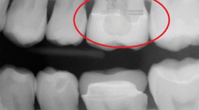Công nghệ của người ngoài hành tinh được tìm thấy trong răng người?
