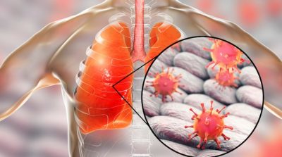 Virus corona có thể trốn sâu trong phổi sau khi bệnh nhân hồi phục